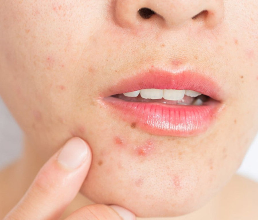  “Combo Mộc” tại ANNIE SPA được thiết kế theo quy trình bài bản, giúp làn da được làm sạch sâu, hấp thụ dưỡng chất tốt hơn và từng bước lấy lại vẻ mịn màng tự nhiên